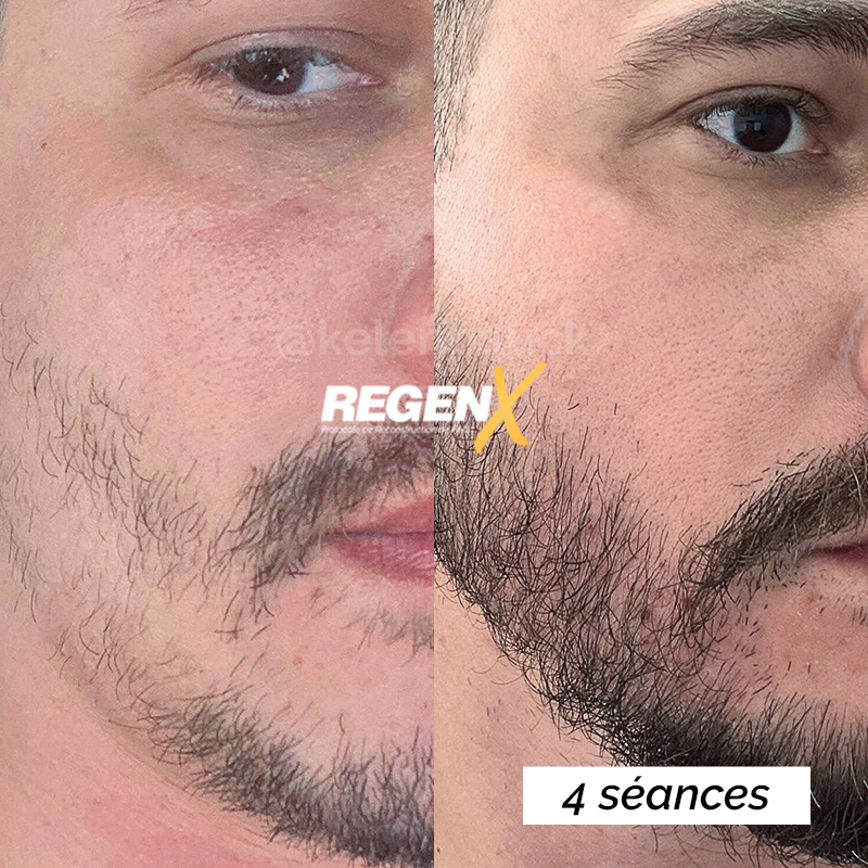 Resultado barba